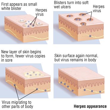 getting-rid-of-herpes